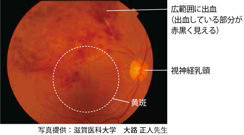 網膜静脈閉塞症（BRVO）の眼の眼底写真